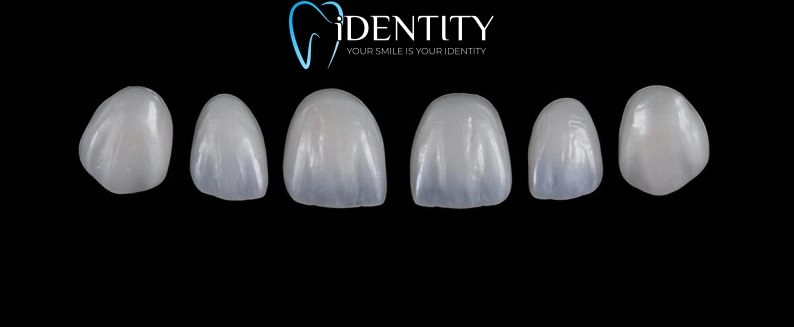Фасети на атрактивна цена в гр. Варна - Дентална клиника IDENTITY от Д-р Ивелина Банчева